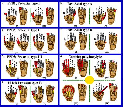 Clinical Genetics of Polydactyly: An Updated Review